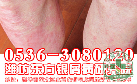 患者对于银屑病的偏方治疗应该抱有怎样的态度