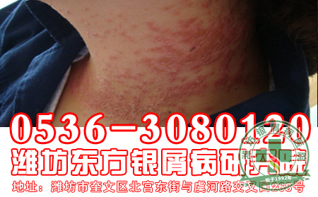治疗银屑病使用偏方要注意什么