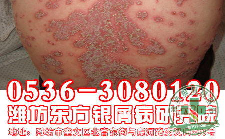 银屑病治疗