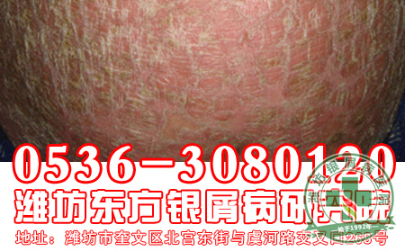 银屑病做好哪些护理工作有助于病情的好转?