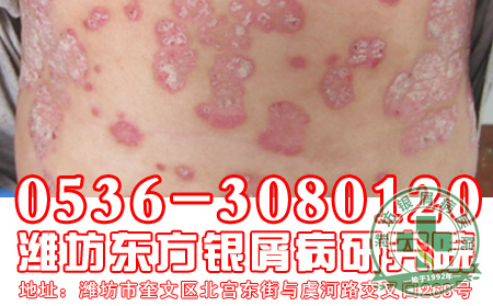 临床上的屈侧银屑病患者应该注意什么？