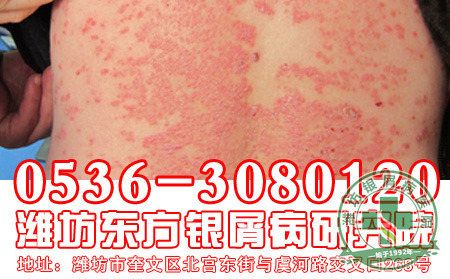 银屑病患者在日常生活中要注意哪些事情?