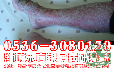 怎样做有助于帮助患者治疗银屑病?