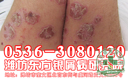 银屑病发病会表现出哪些特征表现?