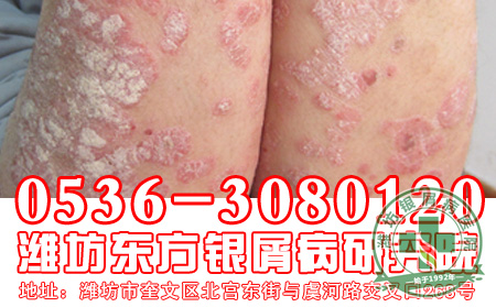 银屑病怎样护理有助于减少皮损加重?