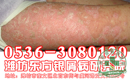 对于银屑病护理患者应该做好哪些？