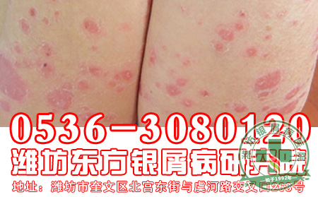 银屑病的遗传问题我们要注意什么?