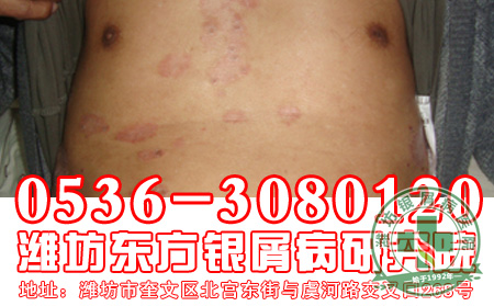 银屑病患者怎样做好银屑病的心理工作？