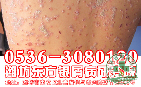银屑病的保健防护怎样做比较好?