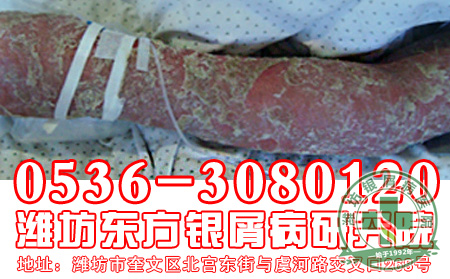 银屑病护理应该做到哪些?