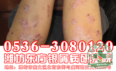 银屑病患者不宜吃的食物有哪些
