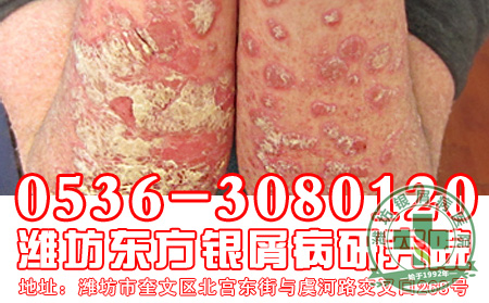 银屑病用药要注意哪些禁忌?