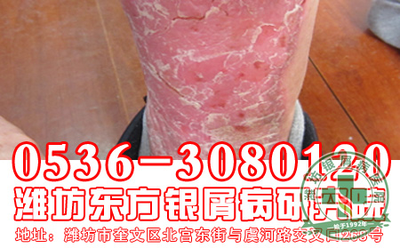 银屑病遗传的表现是怎么样的