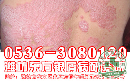 银屑病患者为什么可以食用蜂王浆?