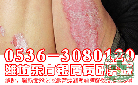银屑病发病后患者怎样做好防护工作好？