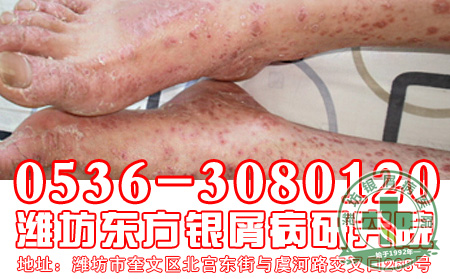 银屑病如果不注意及时治疗会造成什么危害？