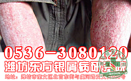 寻常型银屑病的饮食工作要怎么做?