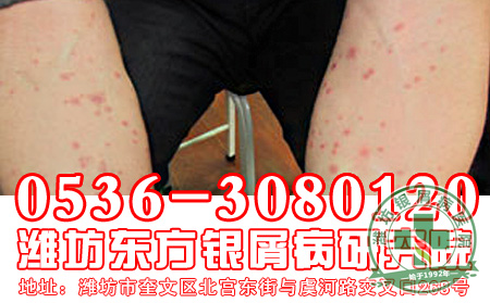 寻常型银屑病的症状和危害是怎样的?