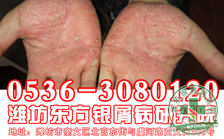 寻常型银屑病在不同部位的发病症状有哪些？