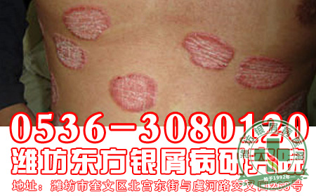 怎样治疗银屑病 好?听听济南银屑病医院主任