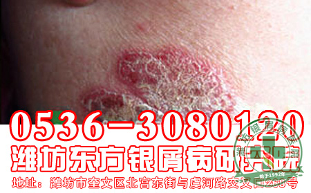 银屑病怎样用药才能减少出现副作用危害?