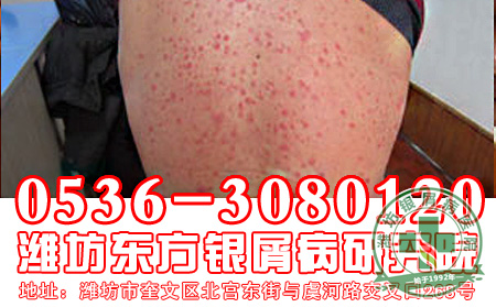 银屑病真的能治好吗?
