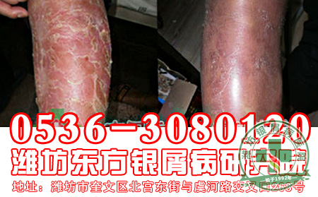 银屑病饮食应该遵循的准则是什么？