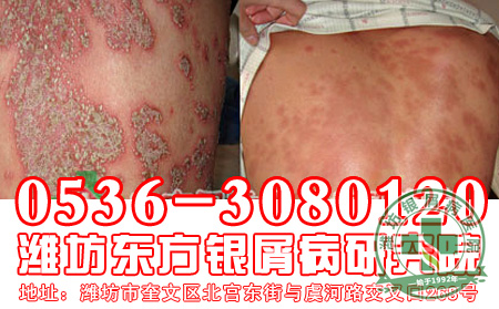寻常型银屑病治疗要做好哪些工作?