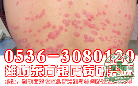 银屑病患者应该多吃哪些食物?
