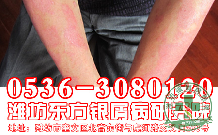 银屑病患者的饮食适宜怎样做?