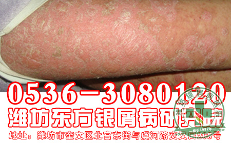 银屑病患者怎样治疗 好?