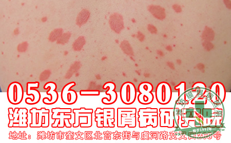 银屑病的护理工作应该怎么做?