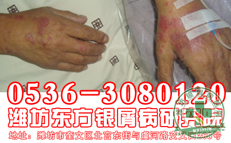 牛皮癣的饮食要做好什么注意工作?