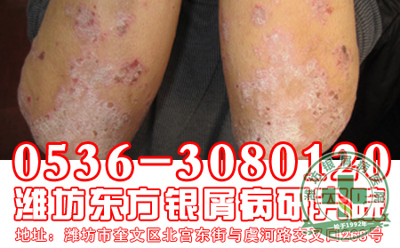 银屑病在遗传过程中患者应该注意什么？