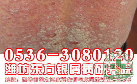 银屑病治疗患者要注意哪些事情?