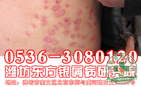 银屑病常用的药物要注意哪些问题?