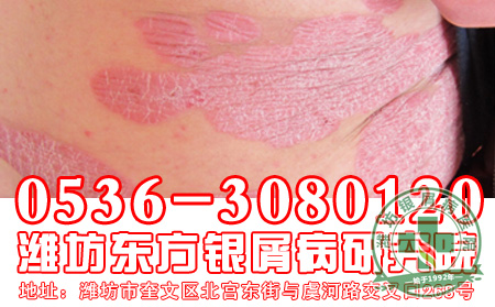 银屑病患者使用药物要注意什么？