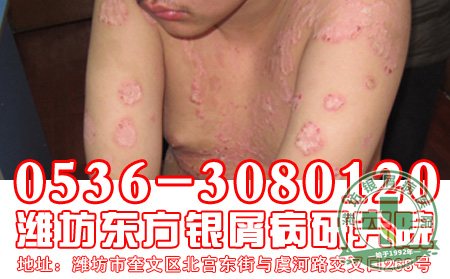 银屑病遗传后一定会发病吗?