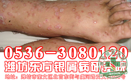对于银屑病的遗传问题患者应该知道什么?