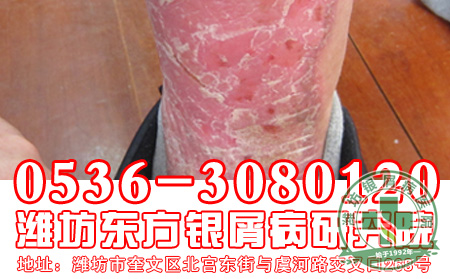 对于银屑病的遗传患者应该注意到哪些问题？
