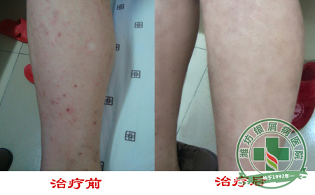 避免遗传银屑病患者用药要注意什么？