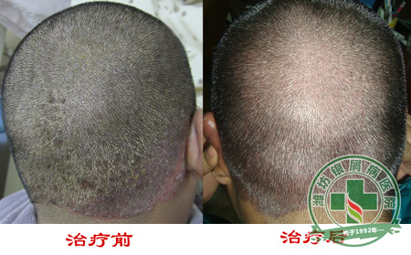 银屑病养护