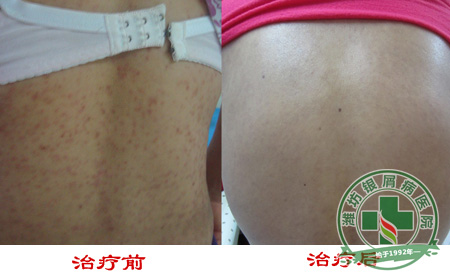 是什么原因导致银屑病患者头发干枯？