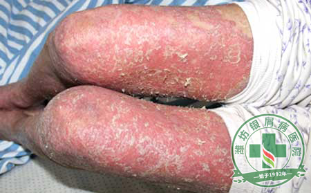 湿疹和银屑病有什么区别?
