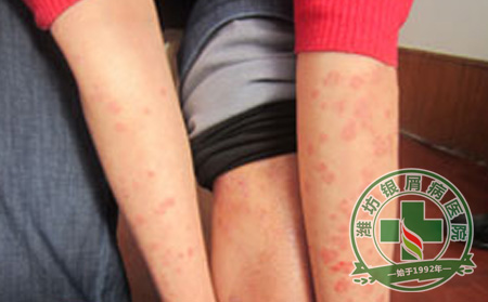 怎样提高银屑病患者的治疗效果？