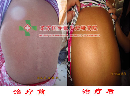 牛皮癣消退期带来哪些症状表现？