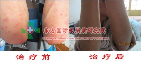 怎么诊断寻常型银屑病 好?