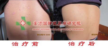 喝粥对于寻常型银屑病治疗好吗?