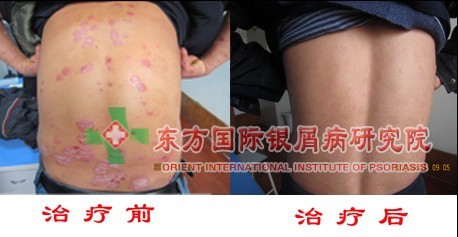 寻常型牛皮癣的不同形态症状表现？