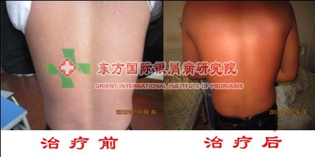 环境不好跟牛皮癣病发有关吗？